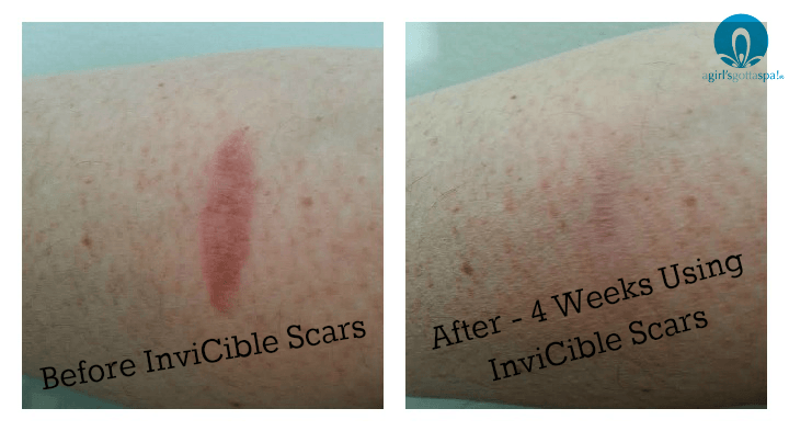 Fade Burn Scars with InviCible Scars - A Girl's Gotta Spa!